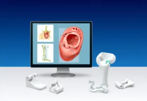 Virtual surgical planning tools and 3D-printed models used in orthopedic surgery